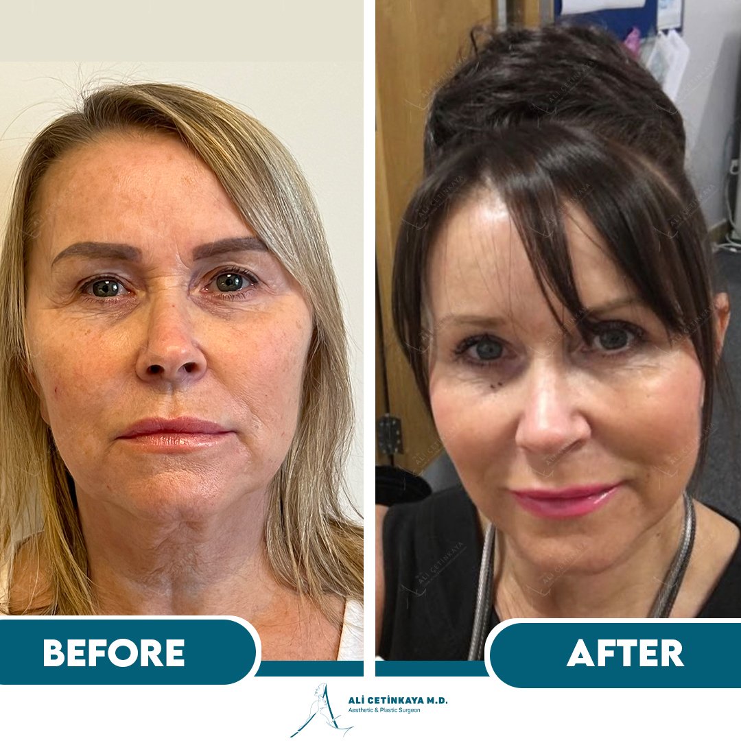 Lynn - Transformation