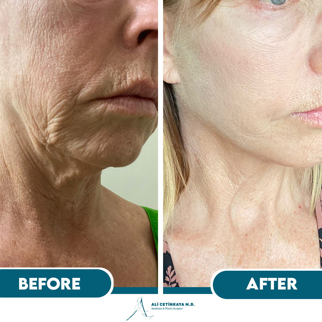 Sara - Before & After