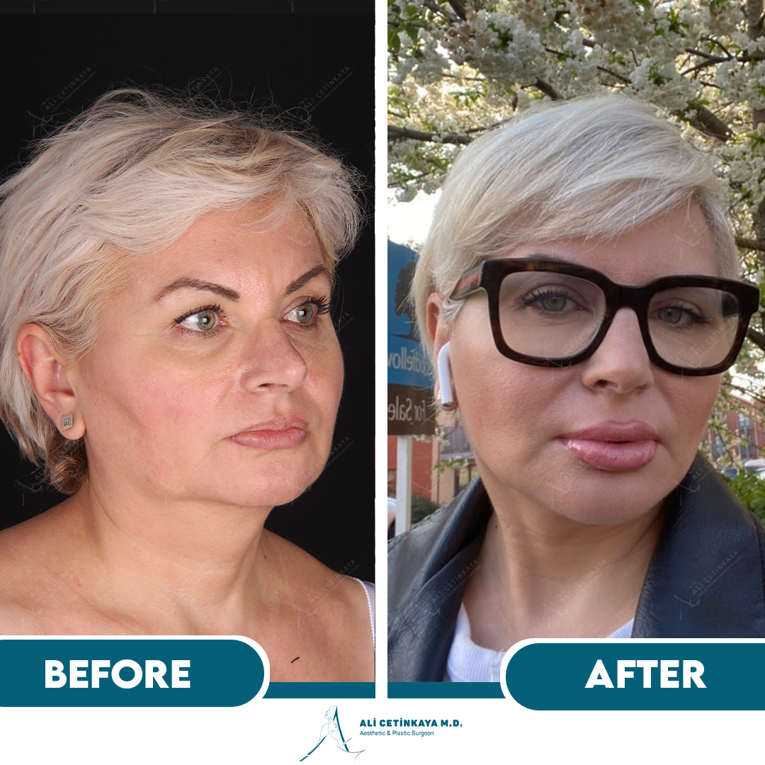 Before Facelift Case 3