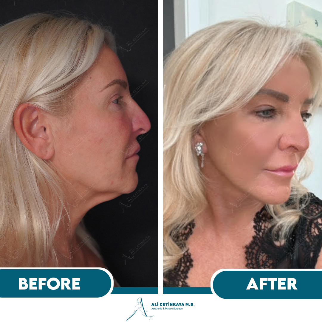 After Facelift Case 3